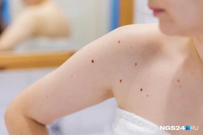 «Это нехороший признак»: насколько опасны треугольные родинки на коже - «Мир женщины»